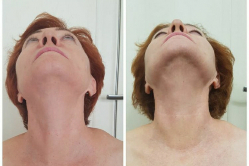 Onde Fazer Rejuvenescimento para Blefaroplastia Bela Cintra - Rejuvenescimento Facial Natural