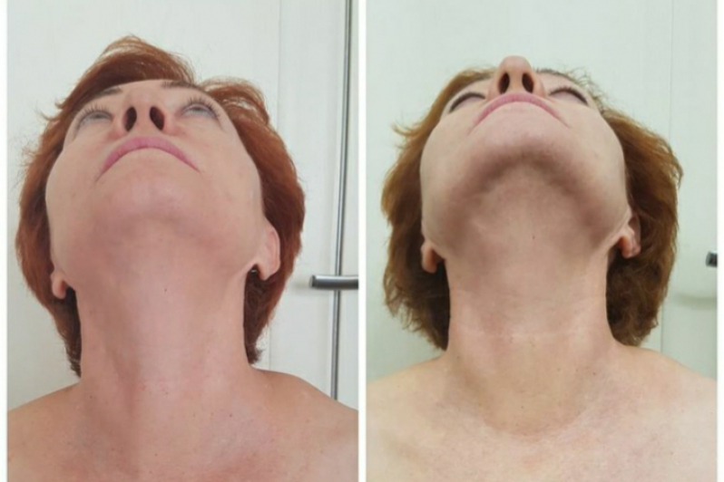 Onde Fazer Rejuvenescimento para Blefaroplastia Praça Da Árvore - Rejuvenescimento Natural Rosto