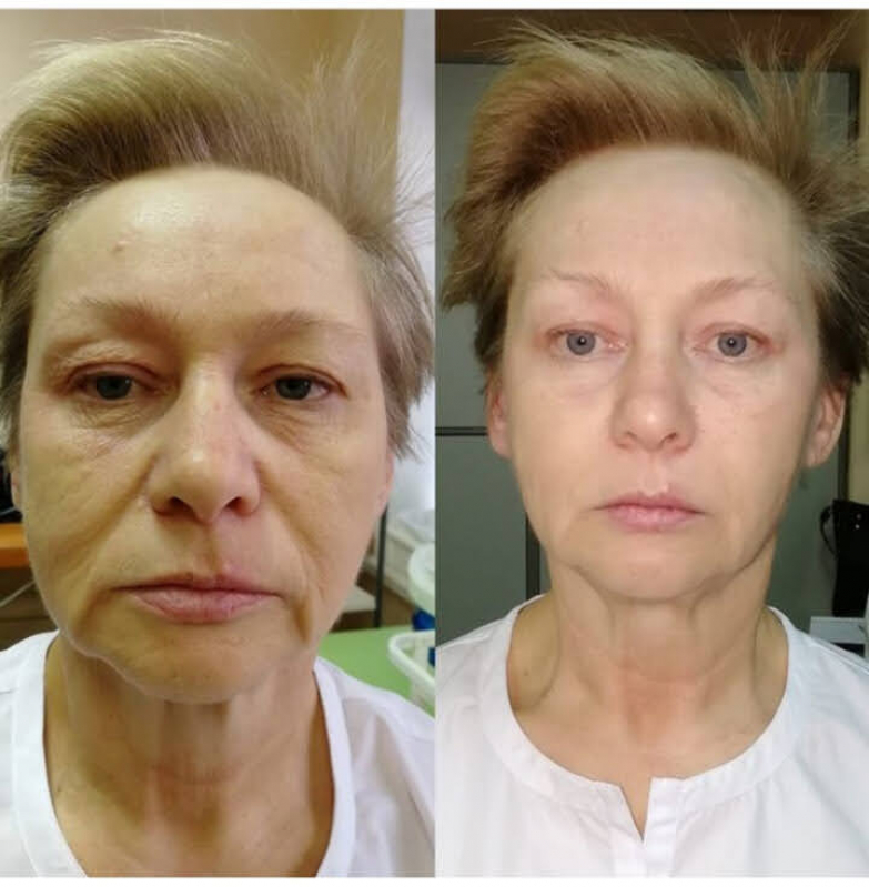 Onde Fazer Rejuvenescimento para Olheiras Chácara Klabin - Rejuvenescimento Facial Natural