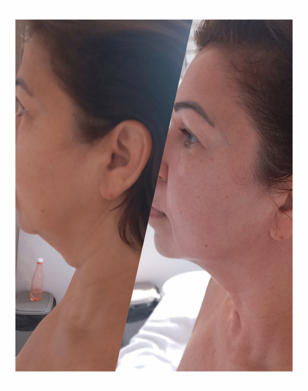 Onde Fazer Rejuvenescimento para Rugas na Testa Ana Rosa - Rejuvenescimento Natural Facial