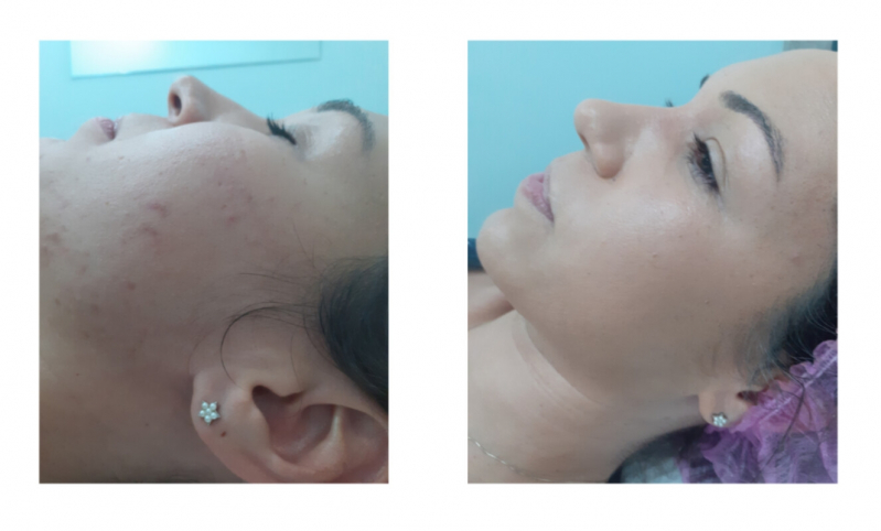 Onde Fazer Tratamento Cicatriz Acne Higienópolis - Tratamento a Laser para Acne
