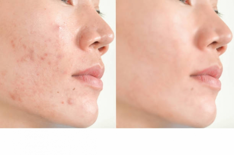 Onde Fazer Tratamento contra Acne Bela Cintra - Tratamento Cicatriz Acne