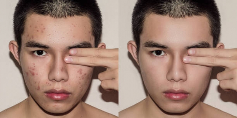 Onde Fazer Tratamento para Cicatriz de Acne Bela Cintra - Tratamento para Manchas de Acne