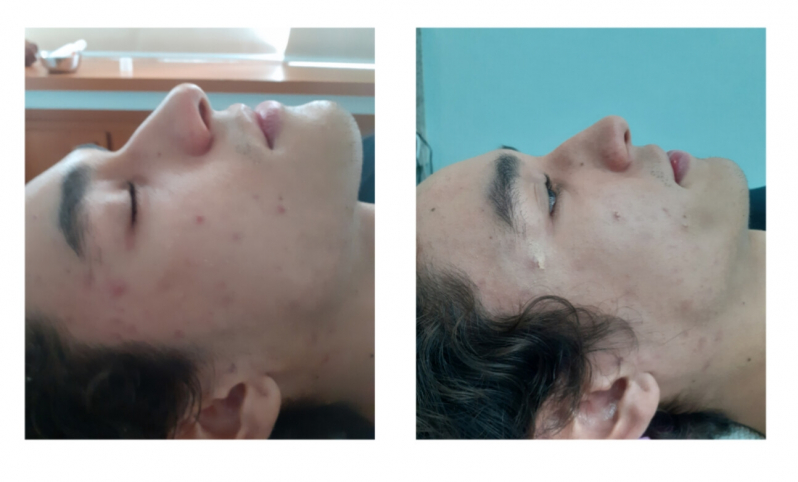 Onde Fazer Tratamento para Marcas de Acne Bela Vista - Tratamento de Acne