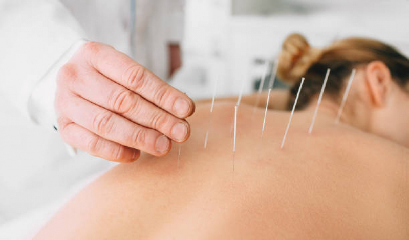 Onde Tem Acupuntura para Dores Musculares Higienópolis - Acupuntura para Nervo Ciático