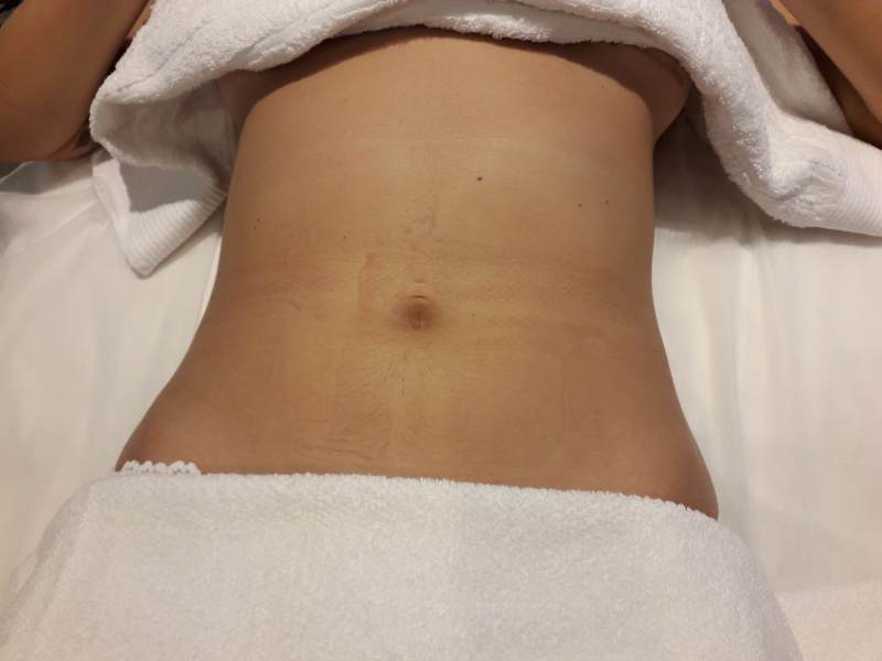 Onde Tem Drenagem Linfática Abdominal Jardins - Drenagem Linfática na Barriga