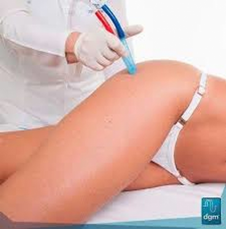 Peeling de Cristal Barato Chácara Klabin - Peeling para Clarear Virilha