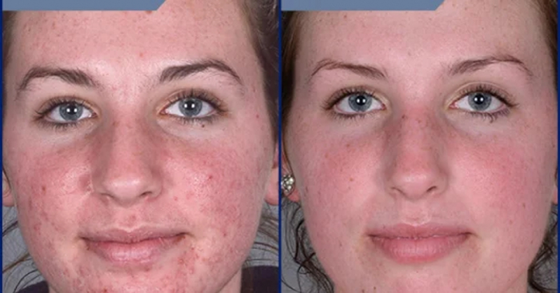 Peeling para Acne Local Vila Mariana - Peeling de Diamante