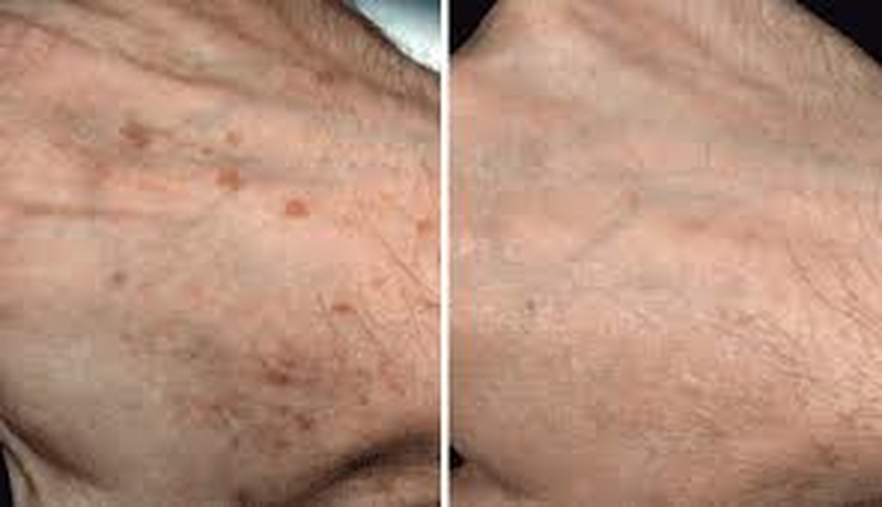 Peeling para as Mãos Vila Madalena - Peeling para Acne