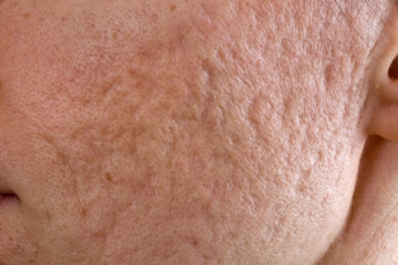 Peeling para Poros Dilatados Bela Vista - Peeling para Acne
