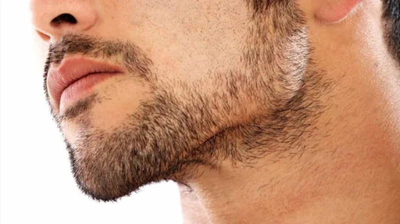 Preenchimento Mandibular Jardins - Preenchimento Labial Masculino