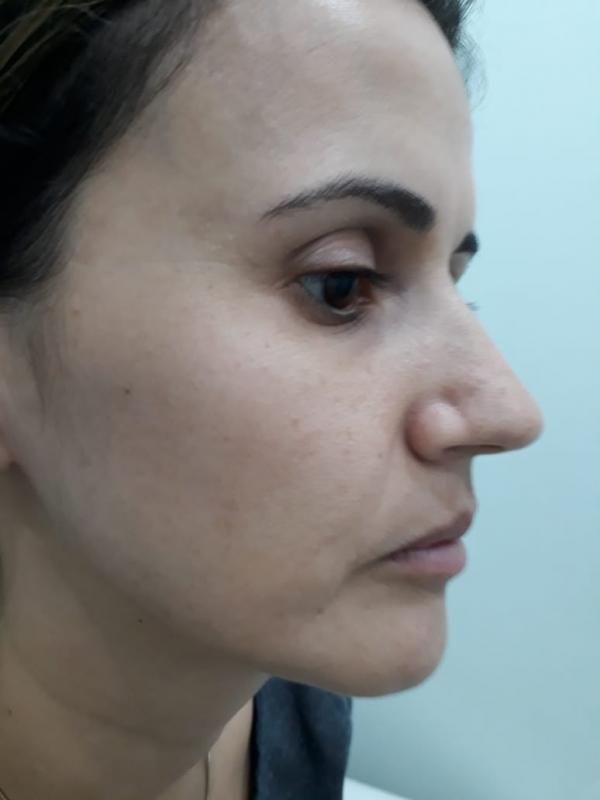 Quanto Custa Limpeza de Pele com Extração Chácara Klabin - Limpeza de Pele Acne