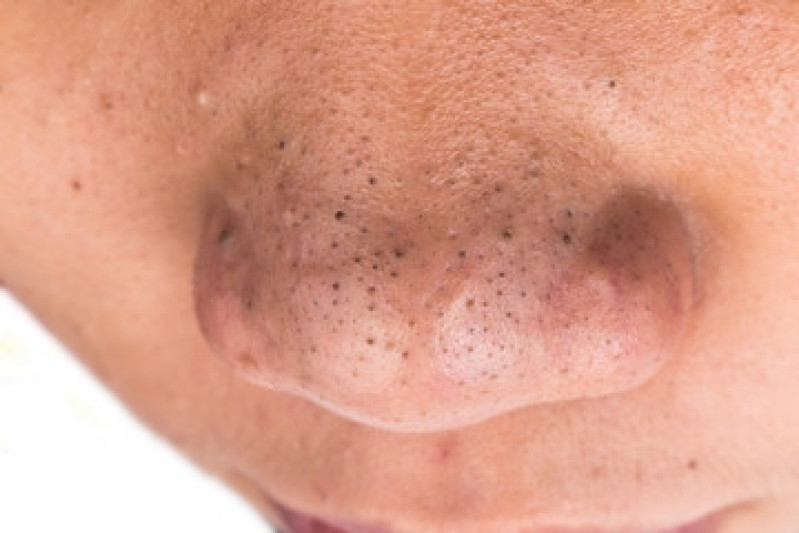 Quanto Custa Limpeza de Pele Cravos Saúde - Limpeza de Pele Acne