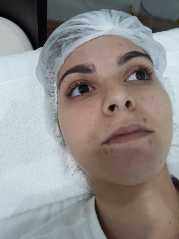 Quanto Custa Limpeza de Pele para Pele Oleosa Chácara Klabin - Limpeza de Pele Acne