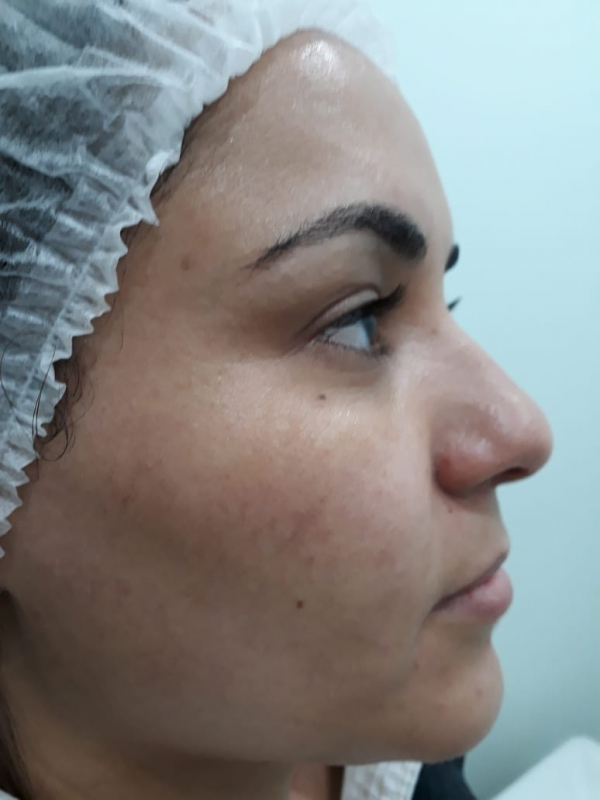 Quanto Custa Limpeza de Pele para Tirar Cravos Chácara Klabin - Limpeza de Pele Acne