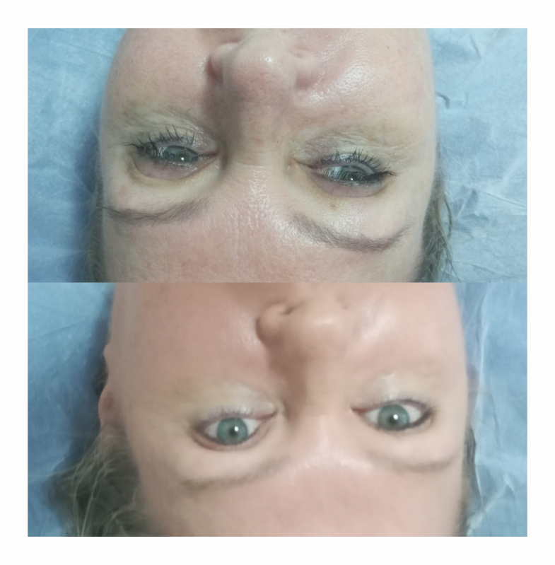 Rejuvenescimento Facial Natural Preço Consolação - Rejuvenescimento para Blefaroplastia