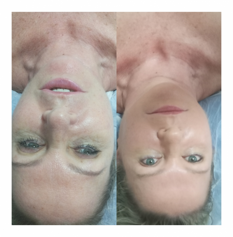 Rejuvenescimento Facial Natural Saúde - Rejuvenescimento para Olheiras