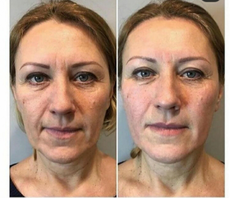 Rejuvenescimento Natural do Rosto Preço Chácara Klabin - Rejuvenescimento para Blefaroplastia