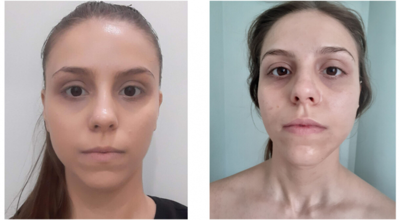 Rejuvenescimento Natural Facial Preço Ana Rosa - Rejuvenescimento Natural Facial
