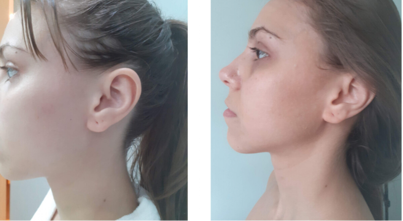 Rejuvenescimento Natural Facial Saúde - Rejuvenescimento para Blefaroplastia