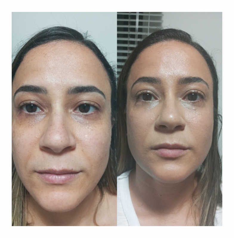 Rejuvenescimento para Flacidez do Rosto Preço Jardim Paulista - Rejuvenescimento Facial Natural