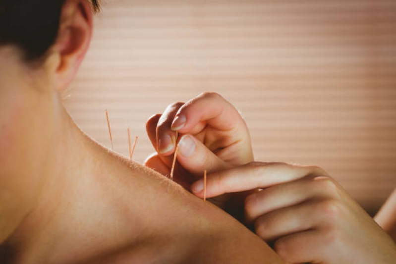 Serviço de Acupuntura para Alteração Hormonal Higienópolis - Acupuntura para Dores Musculares