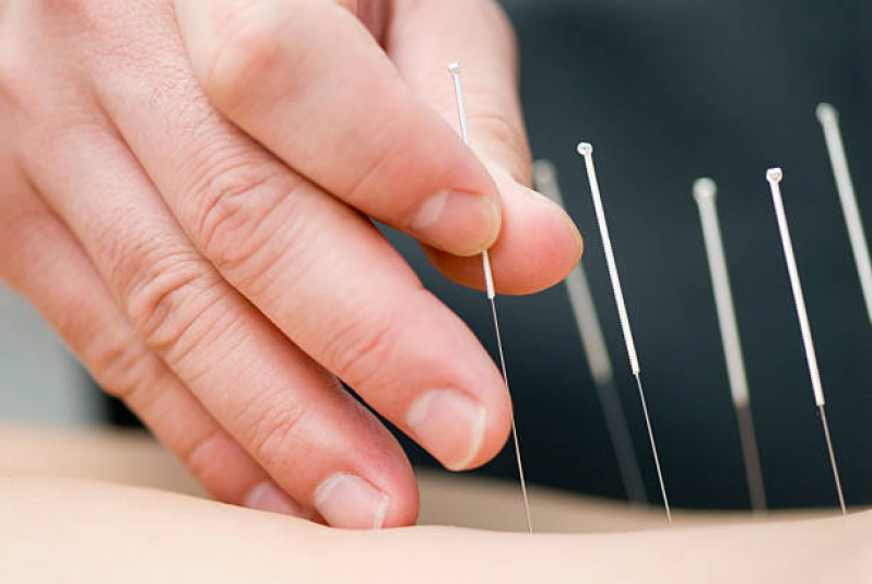 Serviço de Acupuntura para Dores Musculares Saúde - Acupuntura para Dor Lombar