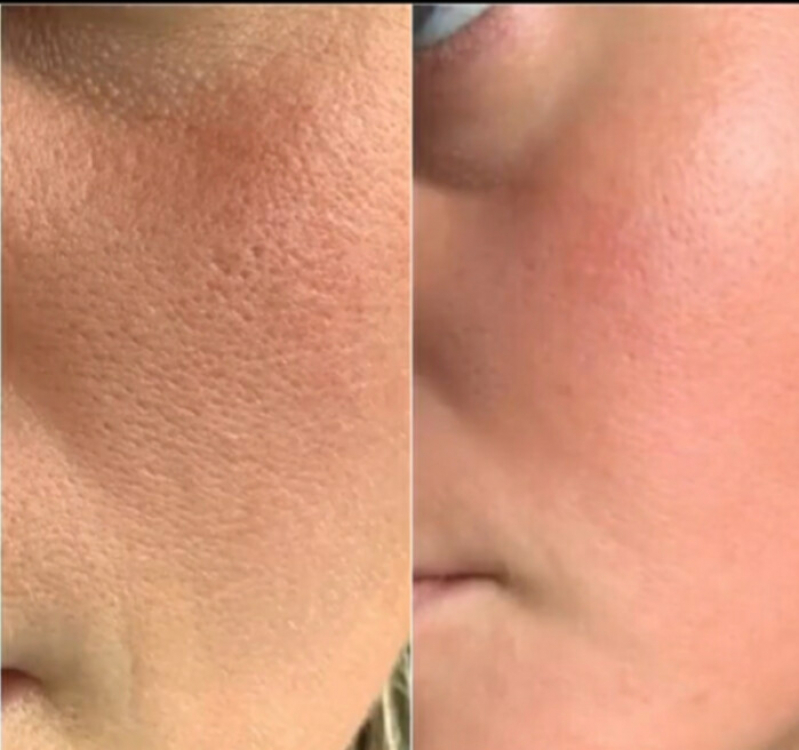 Serviço de Limpeza de Pele com Acne Bela Cintra - Limpeza de Pele Facial