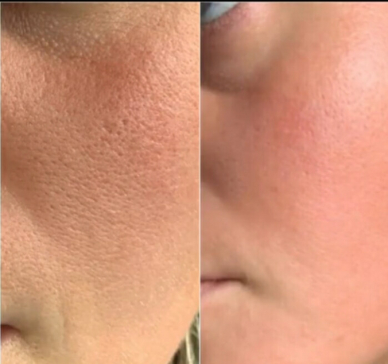 Serviço de Limpeza de Pele com Acne Bela Cintra - Limpeza de Pele Homem