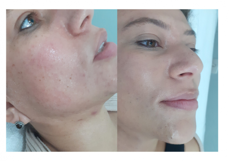 Serviço de Limpeza de Pele com Aplicação de Vitamina Higienópolis - Limpeza de Pele com Acne