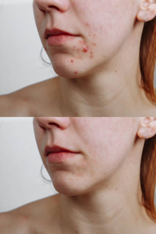 Serviço de Limpeza de Pele para Cicatrizes de Acne Bela Cintra - Limpeza de Pele com Aplicação de Vitamina