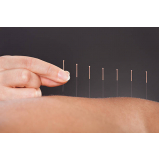 acupuntura para coluna clínica Saúde