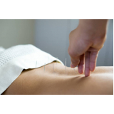 acupuntura para dores musculares clínica Ana Rosa
