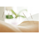 acupuntura para dores musculares Consolação