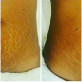 clínica de estética para estrias Bela Cintra