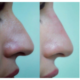 clínica de preenchimento nariz Ana Rosa