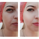 clínica de tratamento para clarear a pele Ana Rosa