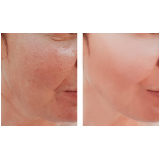 clínica de tratamento para os poros da pele Bela Cintra