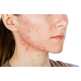 clínica para tratamento a laser para acne Ana Rosa