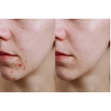 clínica para tratamento acne comprimidos Vila Madalena