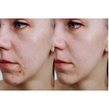 clínica para tratamento acne Saúde