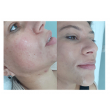 clínica para tratamento cicatriz acne Jardins