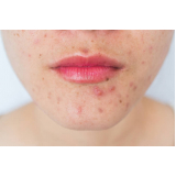 clínica para tratamento contra acne Saúde