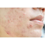 clínica para tratamento para acne e manchas Bela Cintra