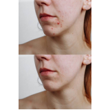 clínica para tratamento para cicatriz de acne Higienópolis