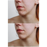 clínica para tratamento para cicatriz de acne Consolação