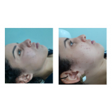 clínica para tratamento para manchas de acne Praça Da Árvore