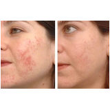 limpeza de pele acne preço Chácara Klabin