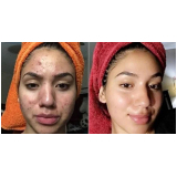 limpeza de pele acne Praça Da Árvore