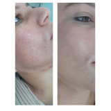 limpeza de pele com acne valor Higienópolis